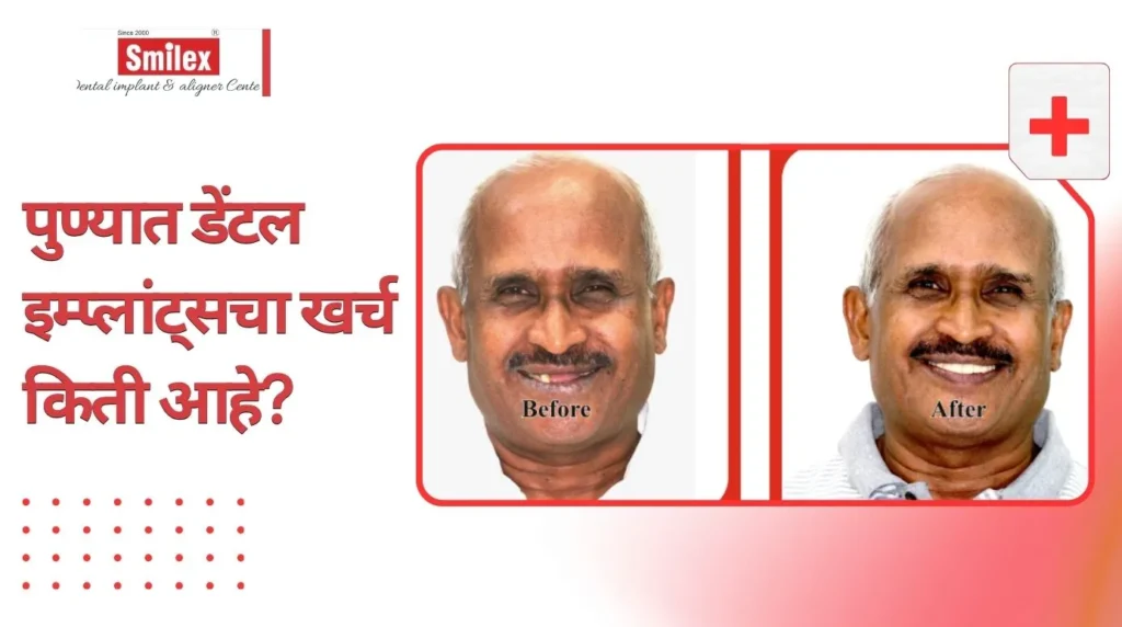 पुण्यात डेंटल इम्प्लांट्सचा खर्च किती आहे? (2026 अपडेट) smilex blog 1 1