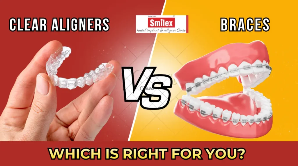 Clear Aligners vs Braces Which Is Right for You smilex blog 15