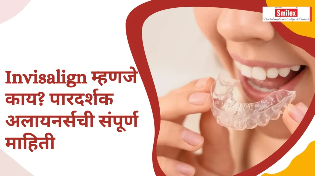 Invisalign म्हणजे काय? पारदर्शक अलायनर्सची संपूर्ण माहिती smilex blog