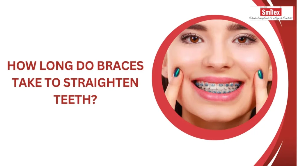 How Long Do Braces Take to Straighten Teeth? smilex blog 19 1