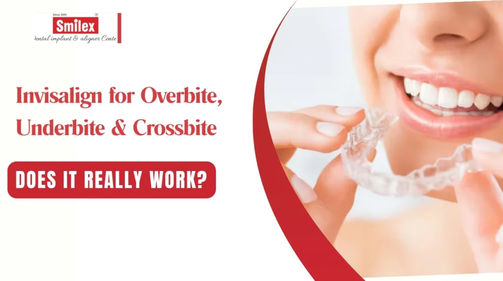 Invisalign for Overbite, Underbite & Crossbite: Does It Really Work? invisalign for overbite underbite crossbite 2.jpg