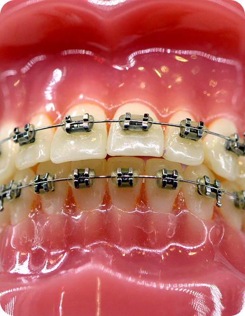 metal braces