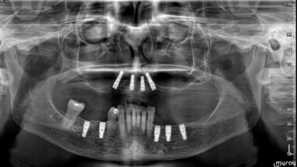 all on 4 implant3
