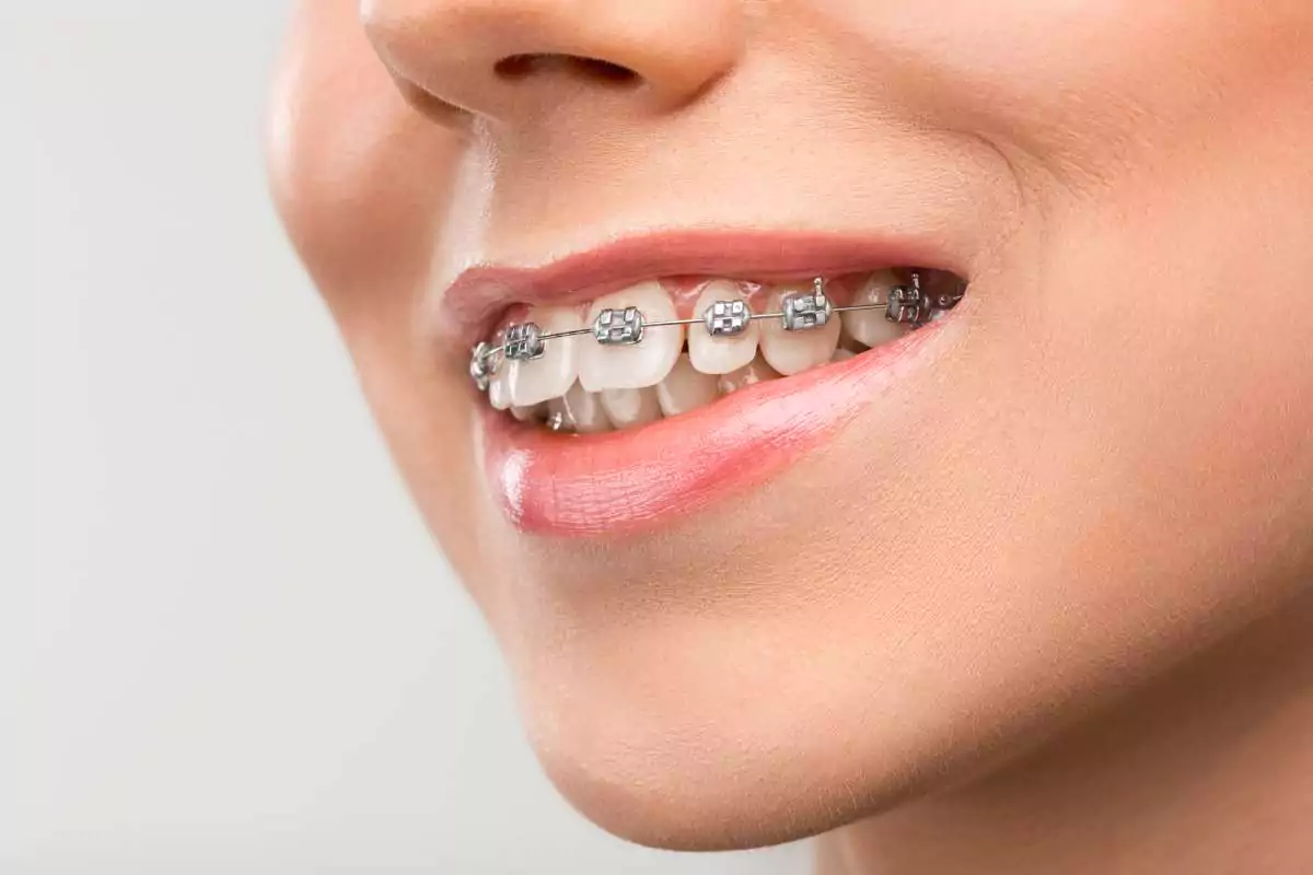 beautiful young woman with teeth braces 1 (1)