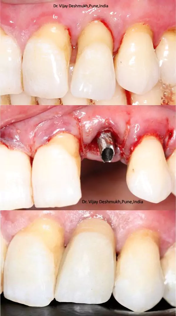 Same Day Dental Implants bf1