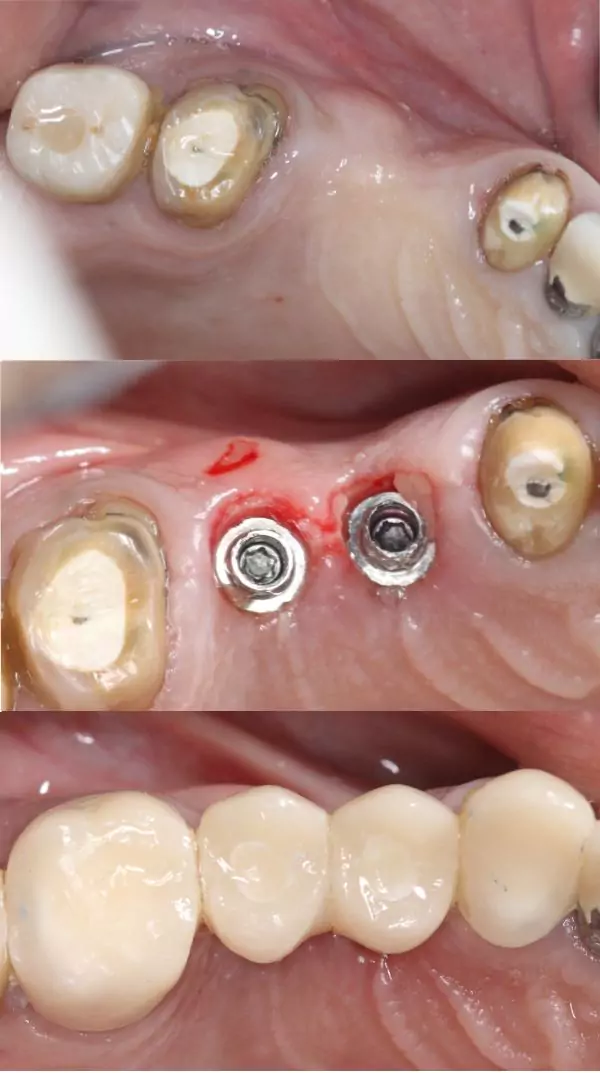 Same Day Dental Implants bf2 (2)
