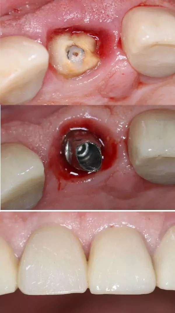 Same Day Dental Implants bf3