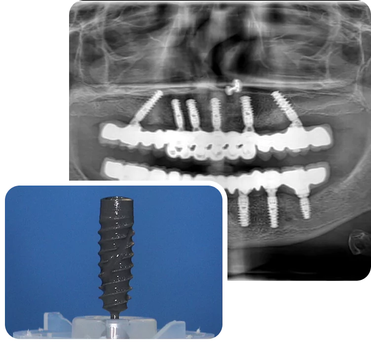 dental implant about