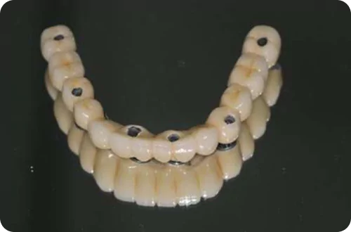 fullmouth implant 1