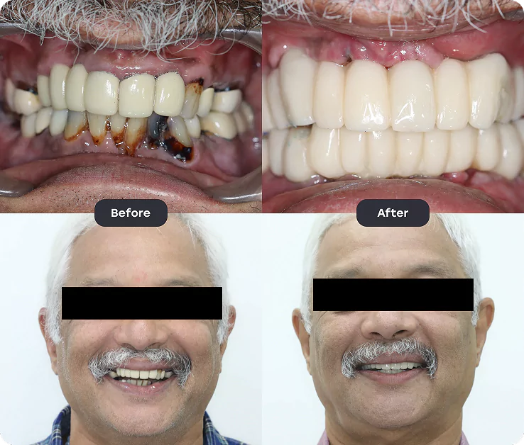 fullmputh before after 2