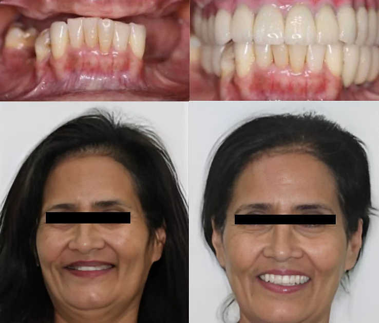 fullmputh before after 3