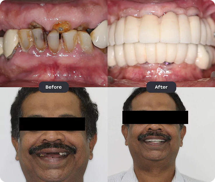 fullmputh before after 4