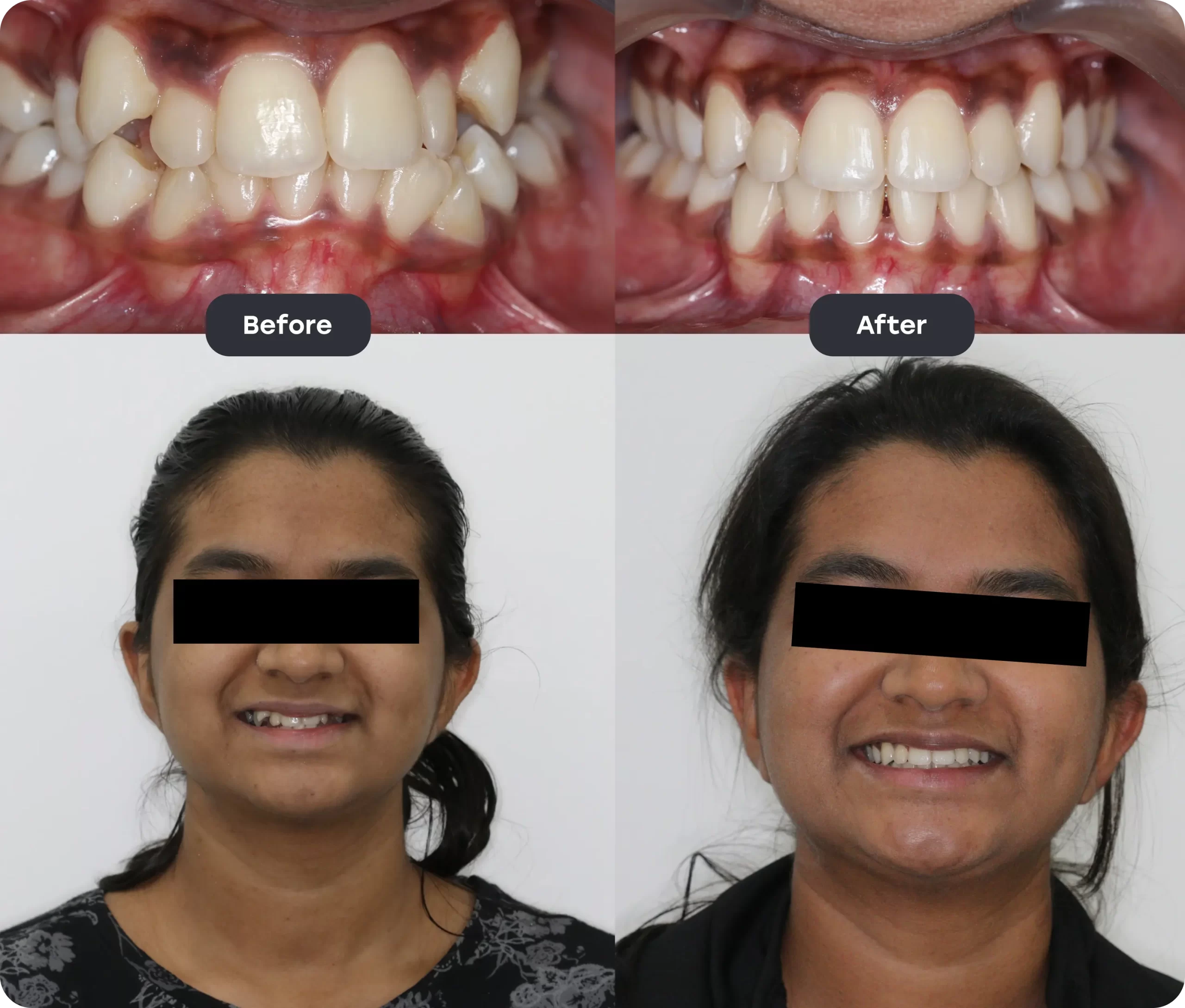 invisalign bef aft 1 scaled