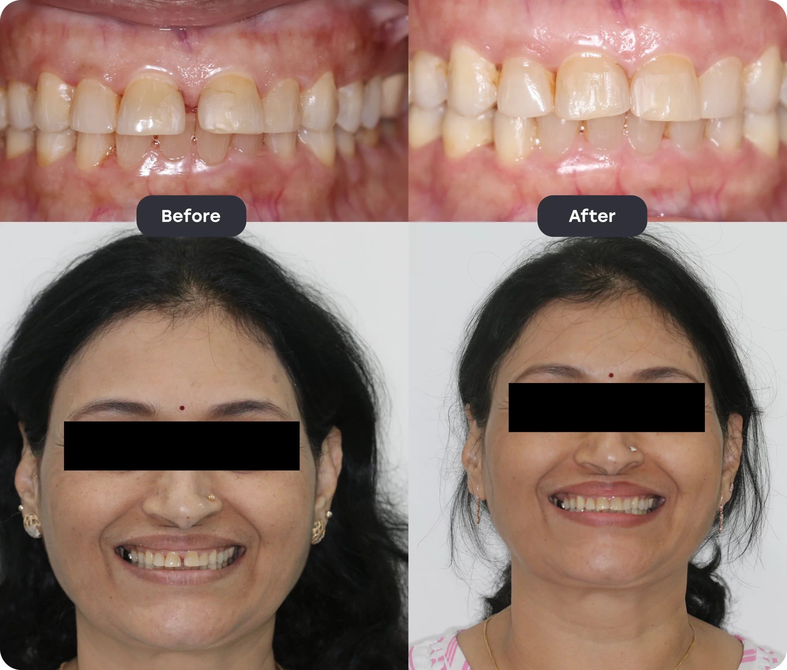 invisalign bef aft 10 scaled