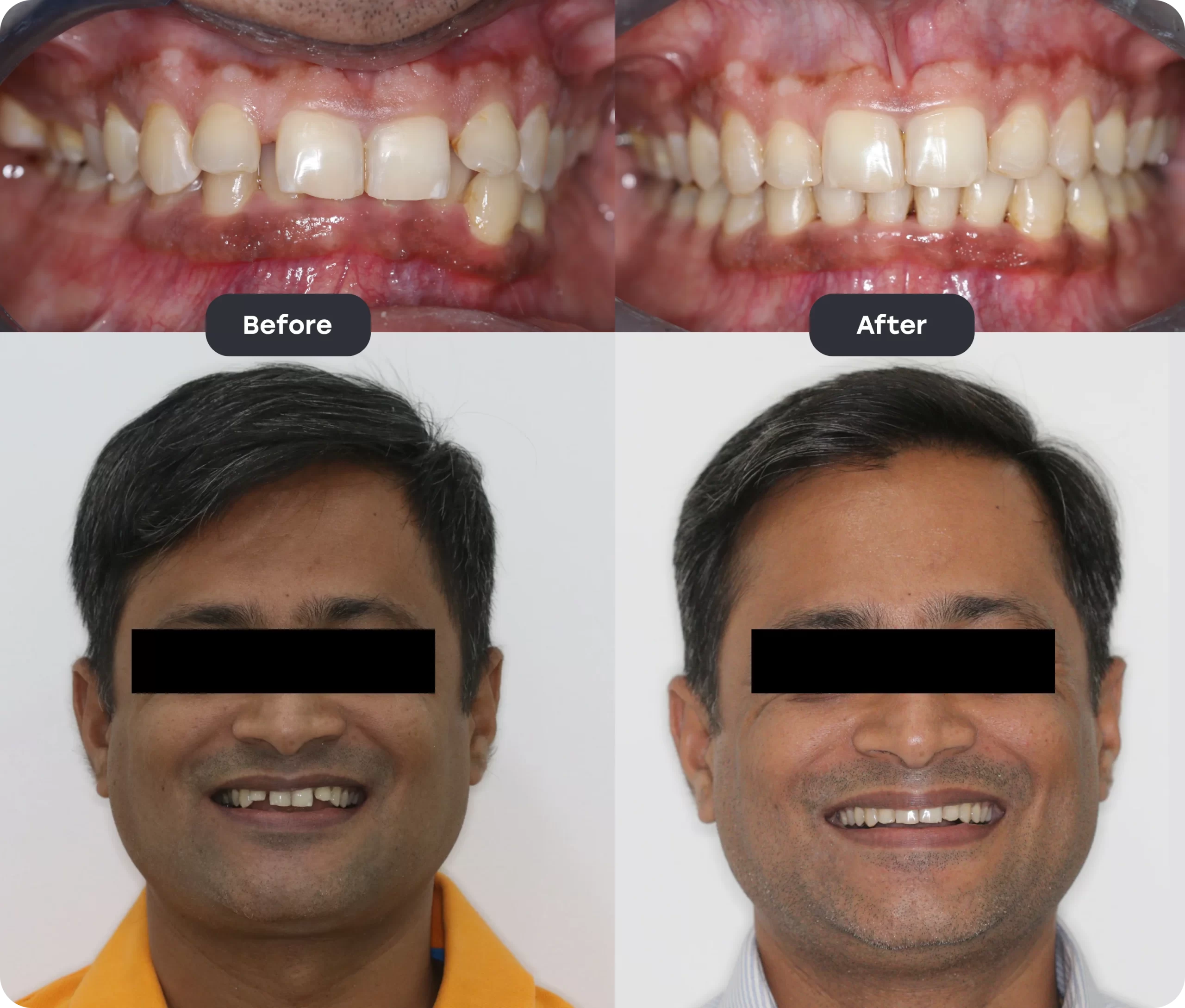 invisalign bef aft 11 scaled