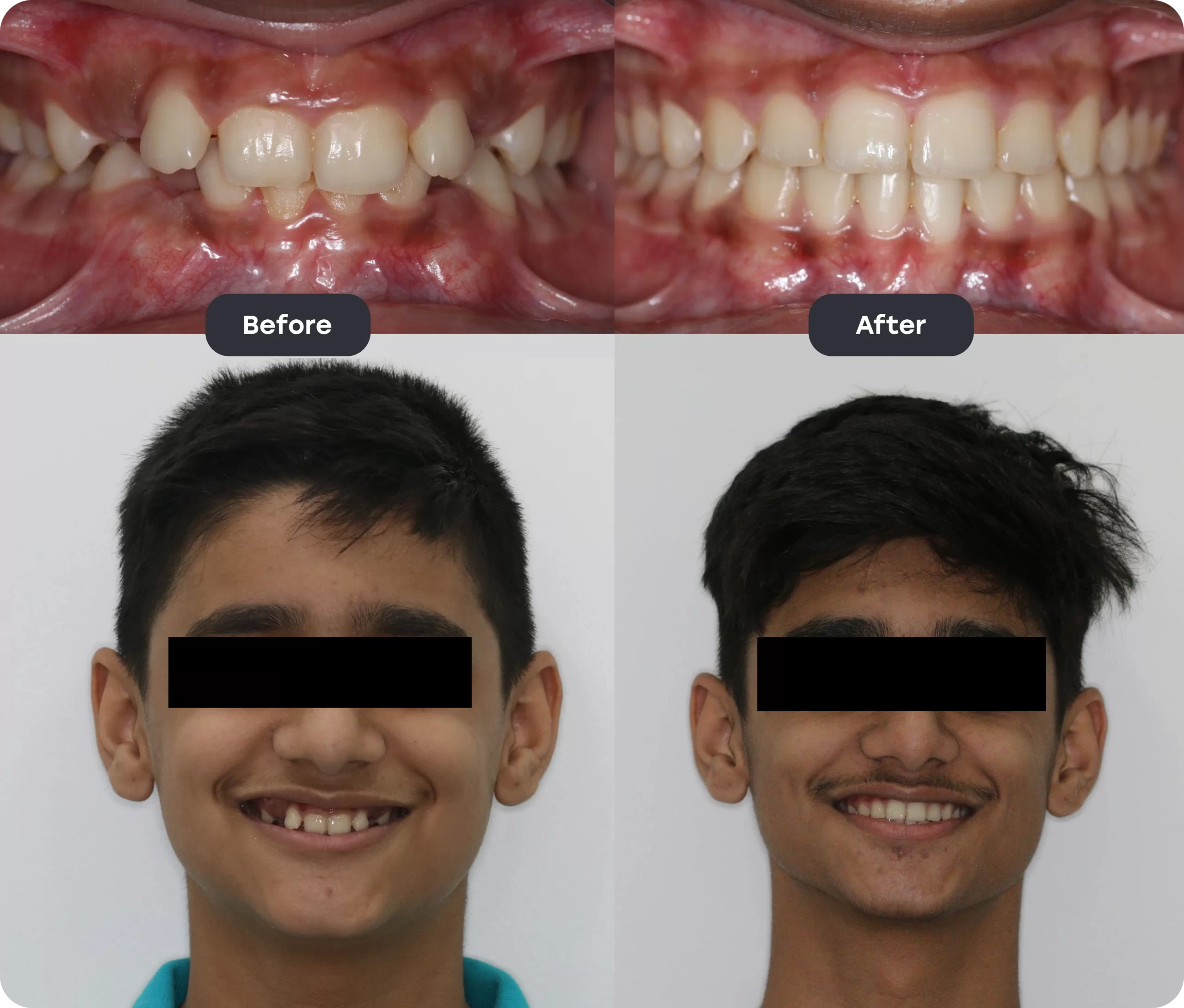 invisalign bef aft 2 scaled