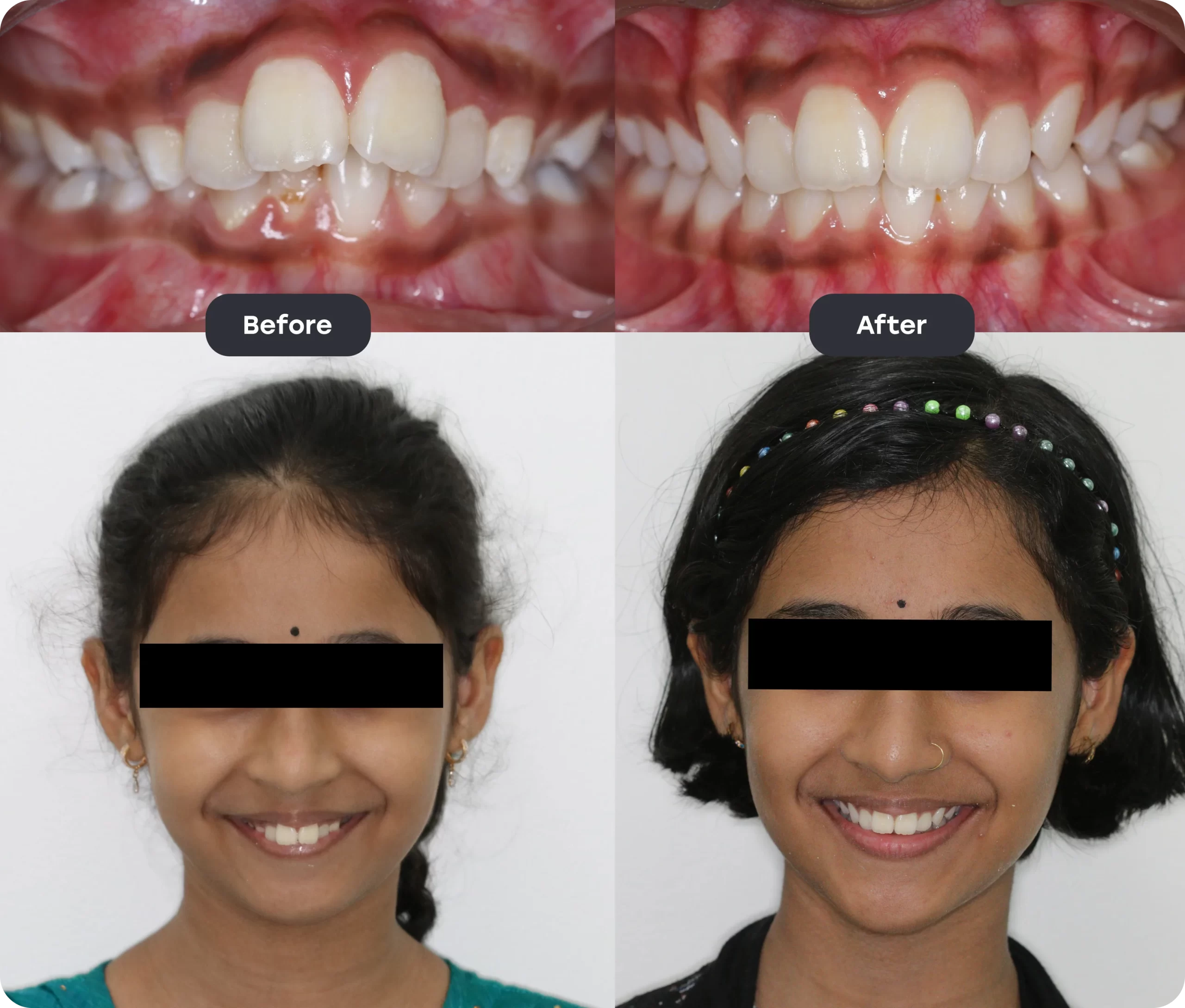 invisalign bef aft 3 scaled