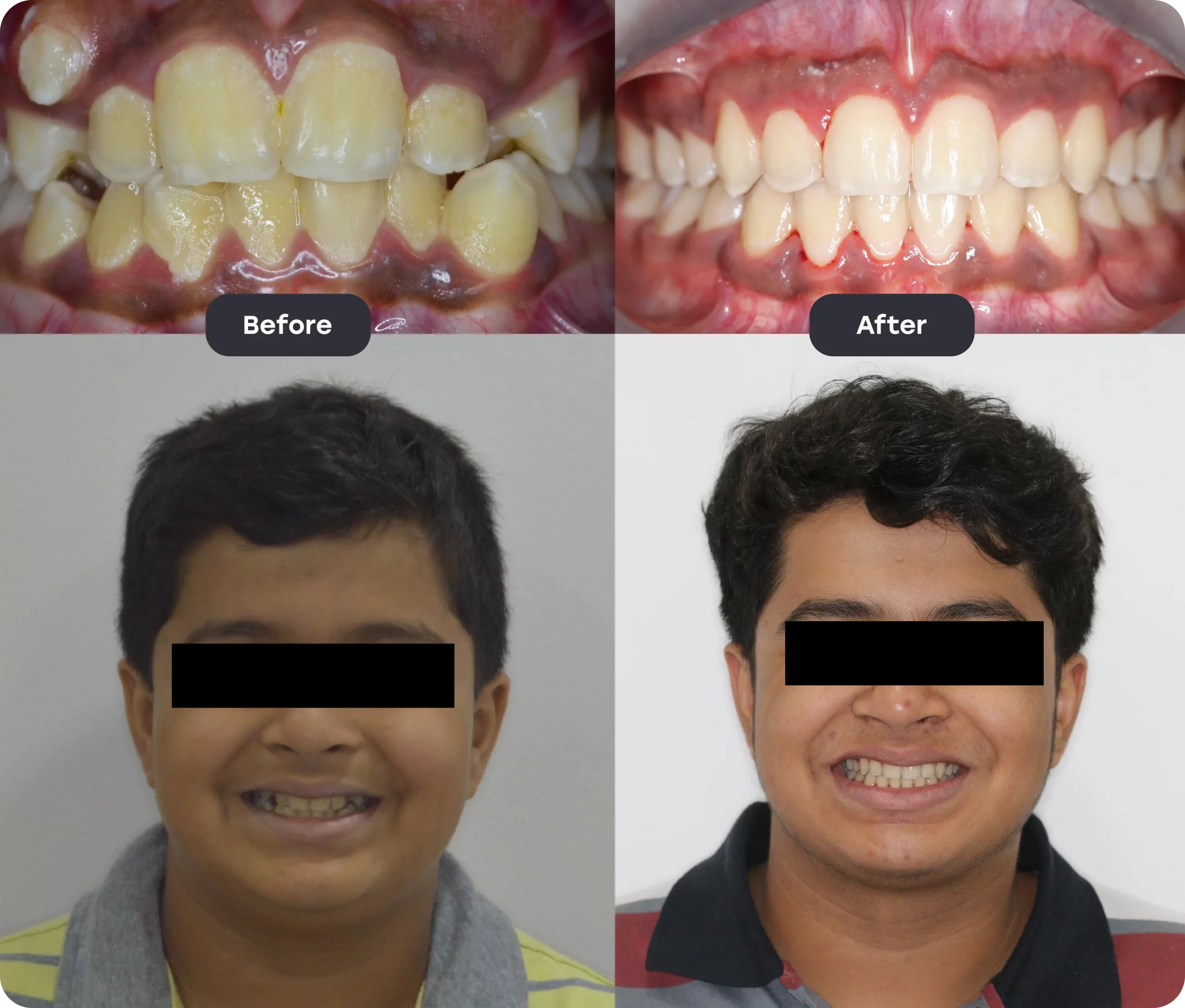 invisalign bef aft 5 scaled
