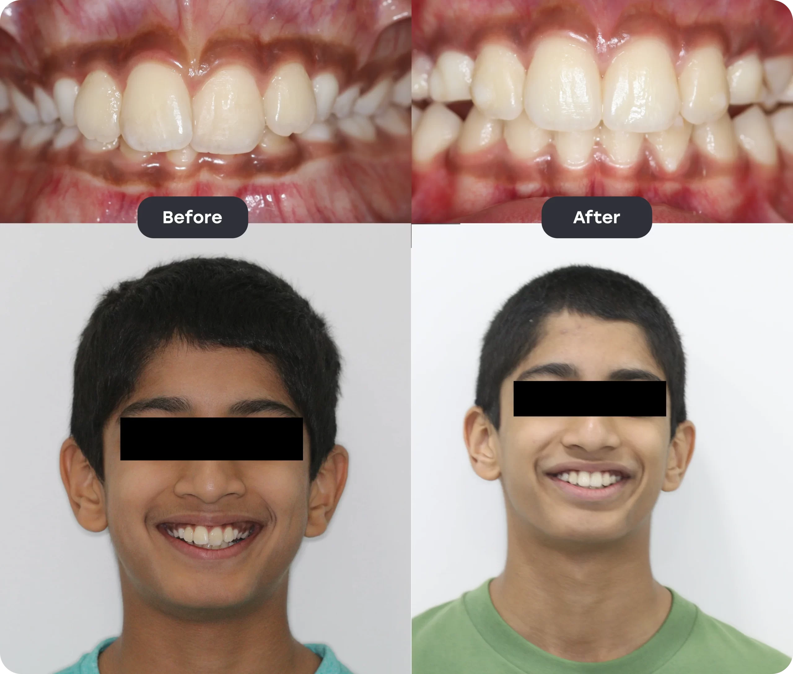 invisalign bef aft 7 scaled