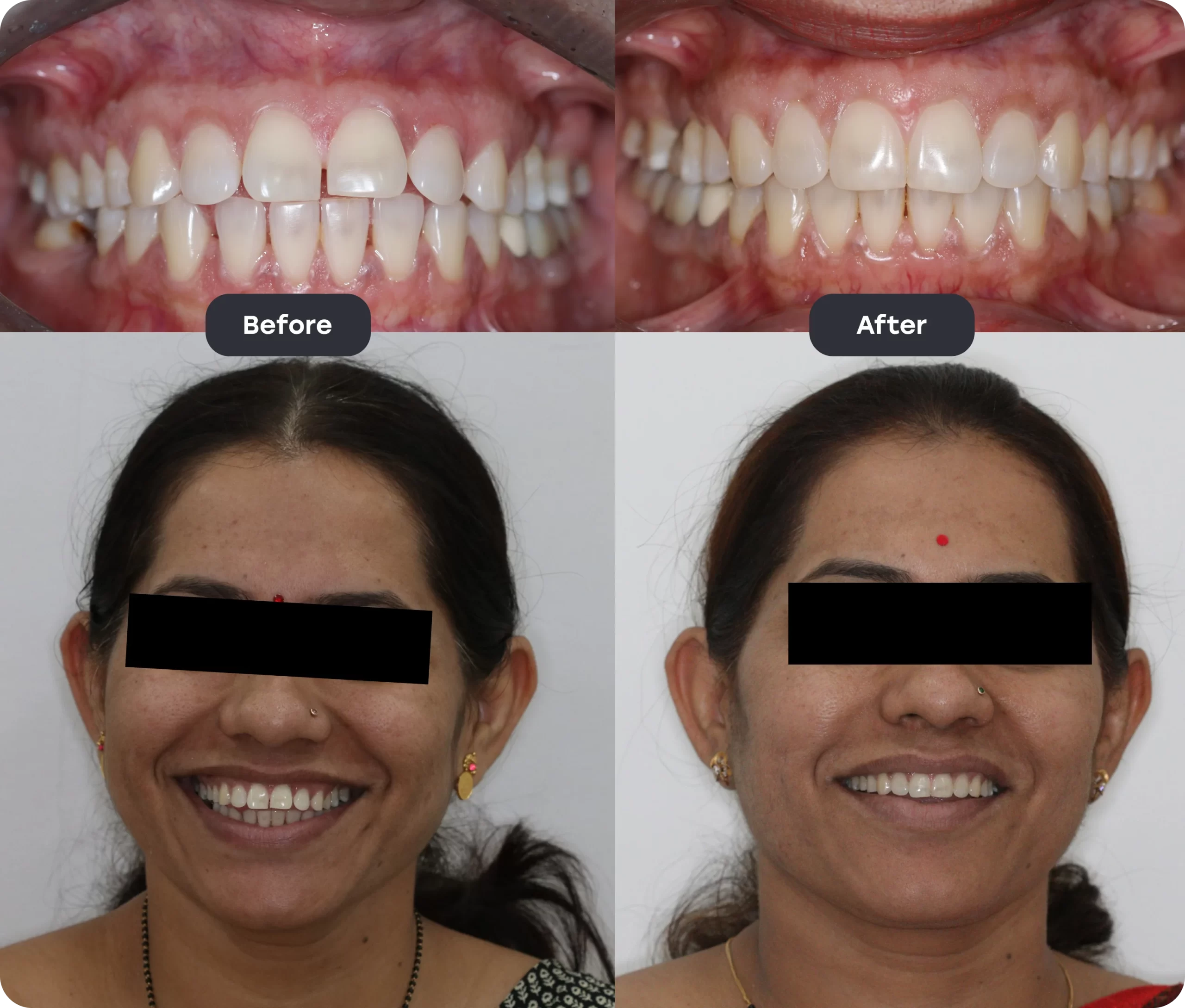 invisalign bef aft 9 scaled