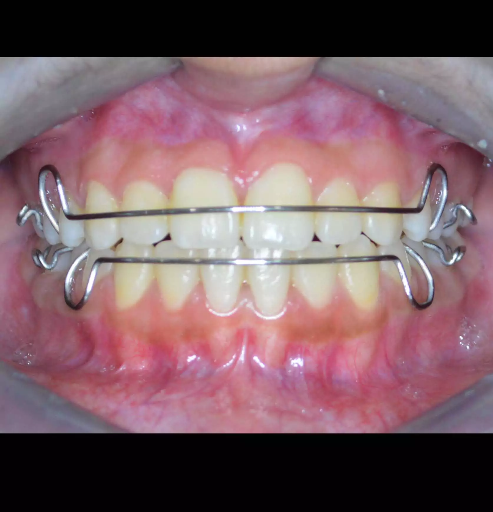 removable braces 2