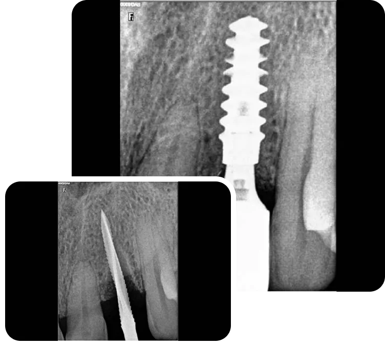 sameday implant about