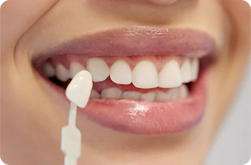 smile designing 1